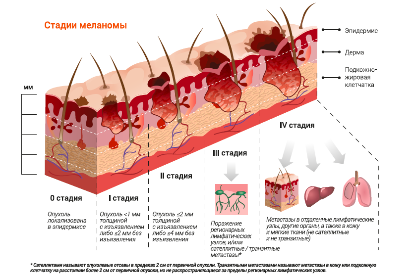 Диета При Меланоме 2 Стадии