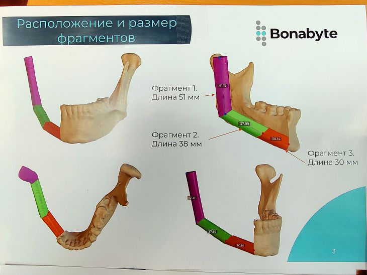 Компьютерное моделирование и кость из голени. Как наши хирурги сделали пациентке с 4-й стадией рака слизистой оболочки щеки новые челюсти.