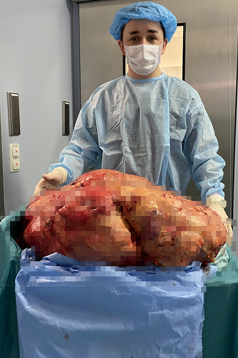 Хирурги Онкоцентра удалили опухоль весом 48,5 кг