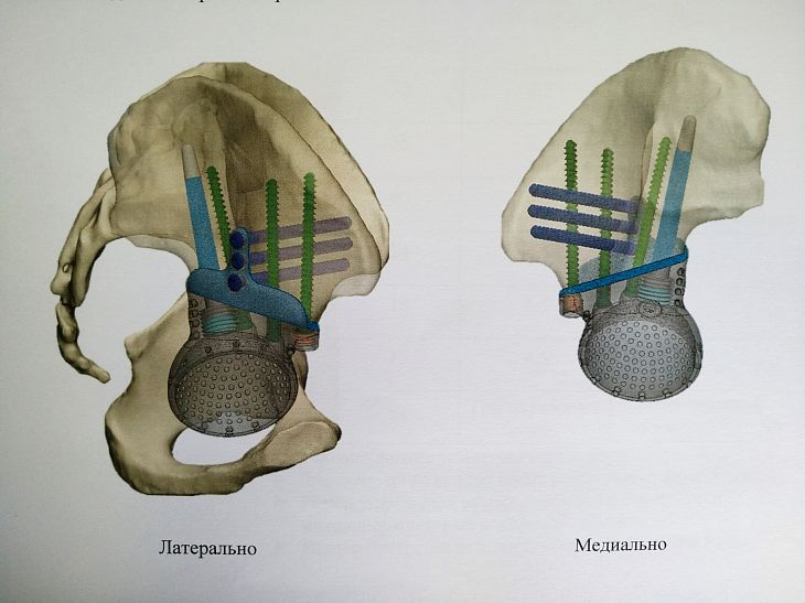 Аутокость и 3D-импланты. Специалисты Онкоцентра творят чудеса при реконструкции поражённых опухолью костей таза.