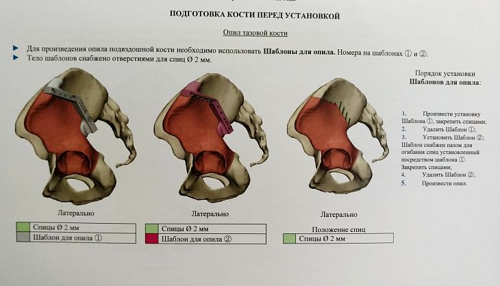 Хирурги онкоцентра впервые провели операцию, применив новейшую реконструктивную технологию с двумя индивидуальными эндопротезами 