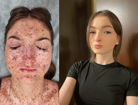 ️Врачи НМИЦ онкологии им. Н.Н. Блохина помогли девушке с редчайшей пигментной ксеродермой, из-за которой воздействие солнца провоцирует развитие злокачественных опухолей кожи