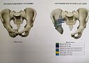 Аутокость и 3D-импланты. Специалисты Онкоцентра творят чудеса при реконструкции поражённых опухолью костей таза.