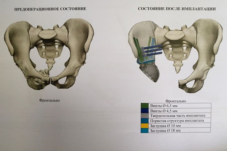 Аутокость и 3D-импланты. Специалисты Онкоцентра творят чудеса при реконструкции поражённых опухолью костей таза.