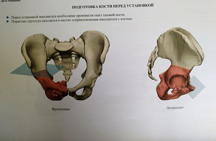 Аутокость и 3D-импланты. Специалисты Онкоцентра творят чудеса при реконструкции поражённых опухолью костей таза.