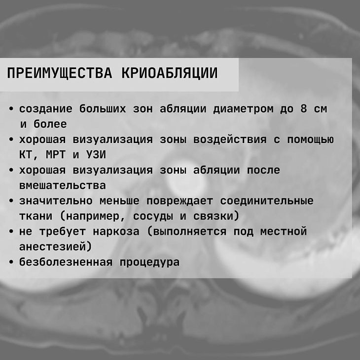 Криоабляция опухолей под ПДКТ-контролем: что нужно знать?