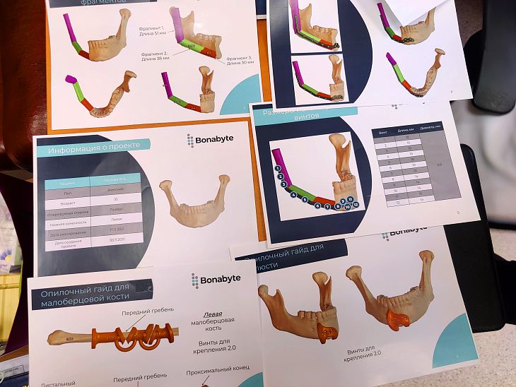 Компьютерное моделирование и кость из голени. Как наши хирурги сделали пациентке с 4-й стадией рака слизистой оболочки щеки новые челюсти.
