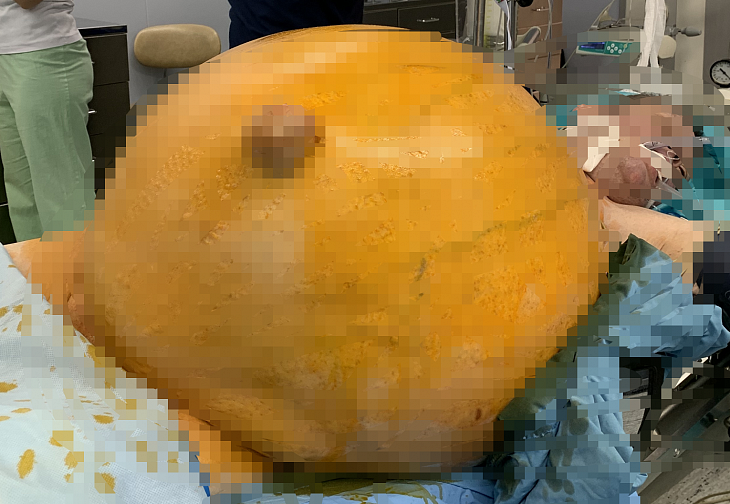 Хирурги Онкоцентра удалили опухоль весом 48,5 кг